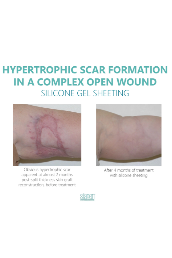 Silagen Silicone Sheeting