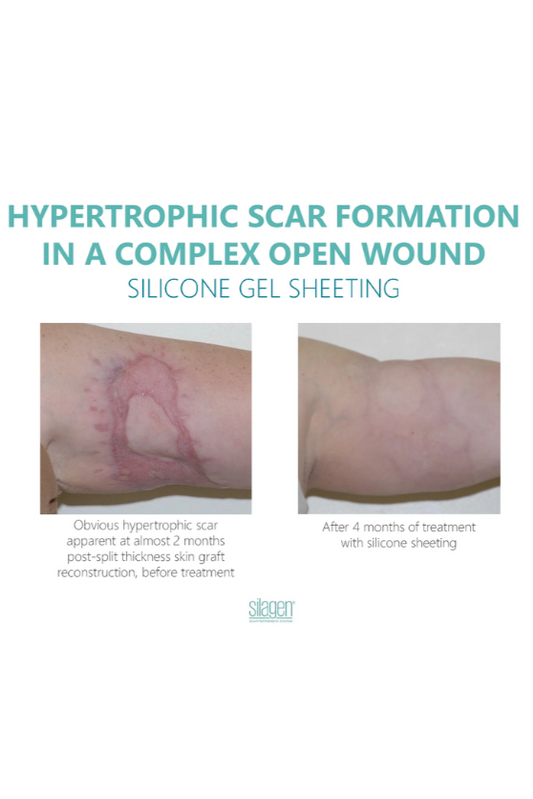 Silagen Silicone Sheeting